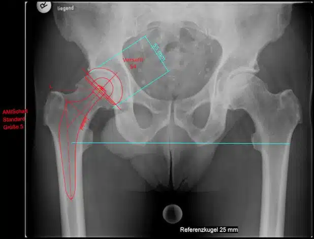OP-Planungsbild am kranken Hüftgelenk (Röntgenbild) - Quelle: St. Franziskus-Hospital gGmbH
